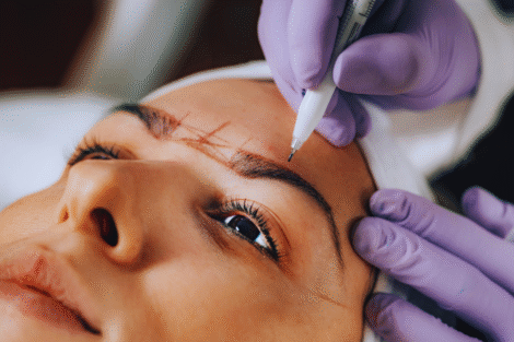 Uma pessoa recebe marcações nas sobrancelhas com uma caneta como parte de um procedimento de nanoblading sobrancelha; mãos usando luvas roxas seguram seu rosto com firmeza.